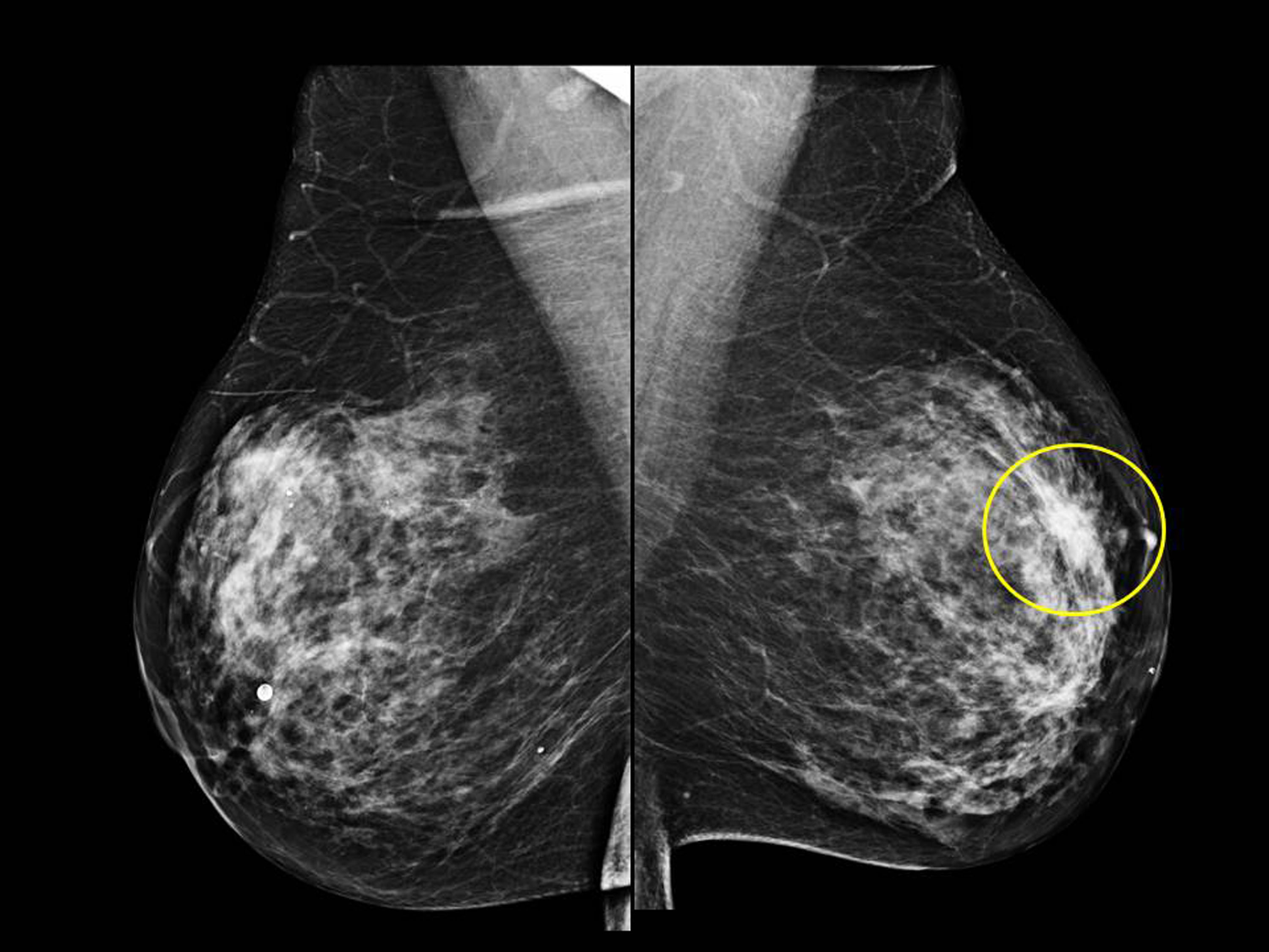 Digital tomosynthesis breast